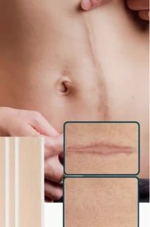 Náplast na strie jizvy pokožky 1ks 